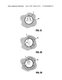 SURGICAL STAPLING DEVICE diagram and image