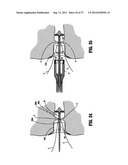 SURGICAL STAPLING DEVICE diagram and image