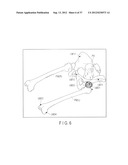 PREOPERATIVE PLANNING PROGRAM AND OPERATION SUPPORT JIG FOR HIP     REPLACEMENT ARTHROPLASTY diagram and image