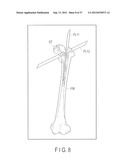 PREOPERATIVE PLANNING PROGRAM AND OPERATION SUPPORT JIG FOR HIP     REPLACEMENT ARTHROPLASTY diagram and image