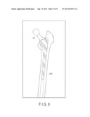 PREOPERATIVE PLANNING PROGRAM AND OPERATION SUPPORT JIG FOR HIP     REPLACEMENT ARTHROPLASTY diagram and image