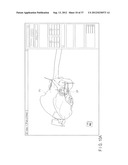 PREOPERATIVE PLANNING PROGRAM AND OPERATION SUPPORT JIG FOR HIP     REPLACEMENT ARTHROPLASTY diagram and image