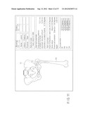 PREOPERATIVE PLANNING PROGRAM AND OPERATION SUPPORT JIG FOR HIP     REPLACEMENT ARTHROPLASTY diagram and image