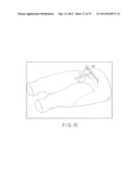 PREOPERATIVE PLANNING PROGRAM AND OPERATION SUPPORT JIG FOR HIP     REPLACEMENT ARTHROPLASTY diagram and image