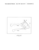 PREOPERATIVE PLANNING PROGRAM AND OPERATION SUPPORT JIG FOR HIP     REPLACEMENT ARTHROPLASTY diagram and image