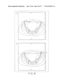 PREOPERATIVE PLANNING PROGRAM AND OPERATION SUPPORT JIG FOR HIP     REPLACEMENT ARTHROPLASTY diagram and image