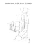 PREOPERATIVE PLANNING PROGRAM AND OPERATION SUPPORT JIG FOR HIP     REPLACEMENT ARTHROPLASTY diagram and image