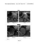 ONCOLYTIC VACCINIA VIRUS COMBINATION CANCER THERAPY diagram and image