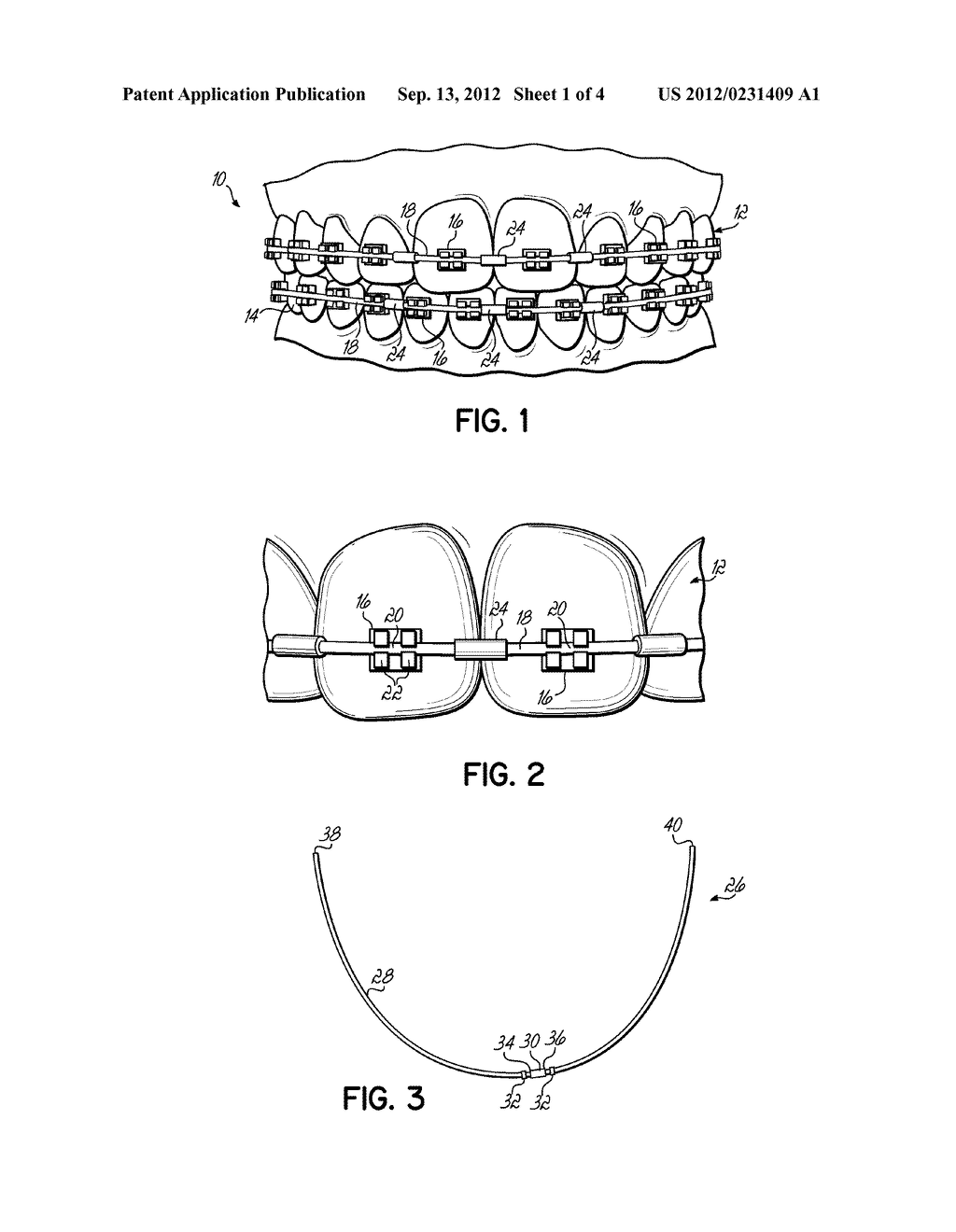 ARCHWIRE ASSEMBLY WITH STOPS - diagram, schematic, and image 02