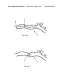 LUMENAL REMODELLING DEVICE AND METHODS diagram and image