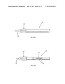 LUMENAL REMODELLING DEVICE AND METHODS diagram and image