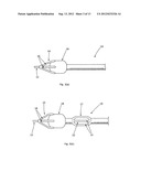 LUMENAL REMODELLING DEVICE AND METHODS diagram and image