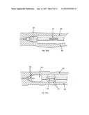 LUMENAL REMODELLING DEVICE AND METHODS diagram and image