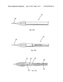 LUMENAL REMODELLING DEVICE AND METHODS diagram and image