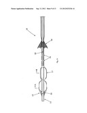 LUMENAL REMODELLING DEVICE AND METHODS diagram and image