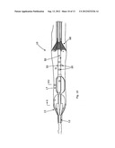 LUMENAL REMODELLING DEVICE AND METHODS diagram and image