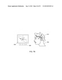 MAGNETIC-BASED METHODS FOR TREATING VESSEL OBSTRUCTIONS diagram and image