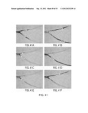 MAGNETIC-BASED METHODS FOR TREATING VESSEL OBSTRUCTIONS diagram and image