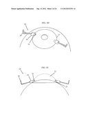 IRIS RETRACTOR diagram and image