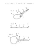 IRIS RETRACTOR diagram and image