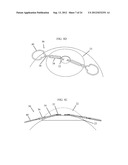 IRIS RETRACTOR diagram and image