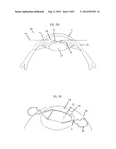 IRIS RETRACTOR diagram and image