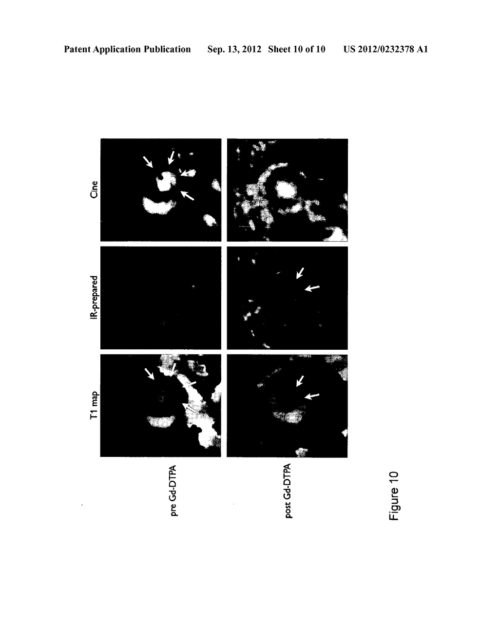 Look-Locker IR-SSFP for Cardiac MR Imaging with Simultaneous Generation of     Cardiac T1 Maps, Cine Images and IR-Prepared Images - diagram, schematic, and image 11