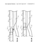 SHORT WIRE CABLE CATHETER diagram and image