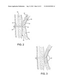 Medical Device for use with a Stoma diagram and image
