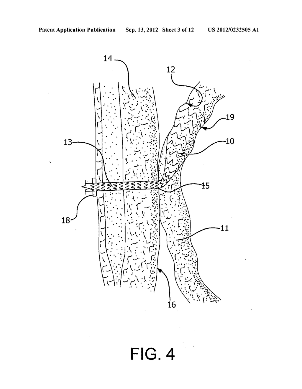 Medical Device for use with a Stoma - diagram, schematic, and image 04