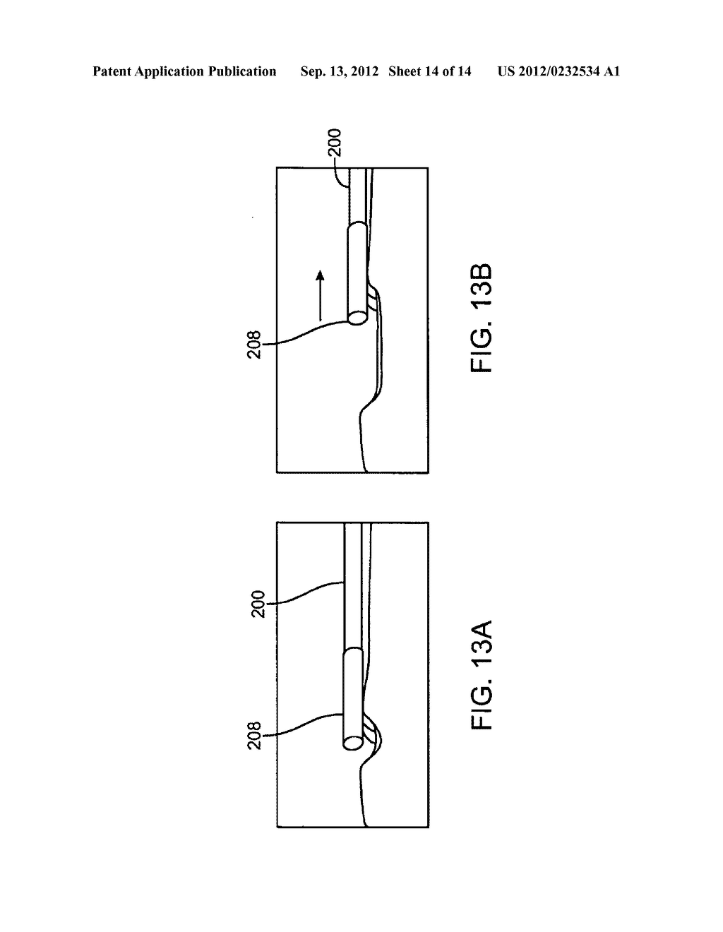 MULTI-WAVELENGTH LASER AND METHOD FOR CONTACT ABLATION OF TISSUE - diagram, schematic, and image 15