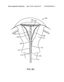 SYSTEM AND METHOD FOR ENDOMETRIAL ABLATION diagram and image