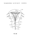 SYSTEM AND METHOD FOR ENDOMETRIAL ABLATION diagram and image