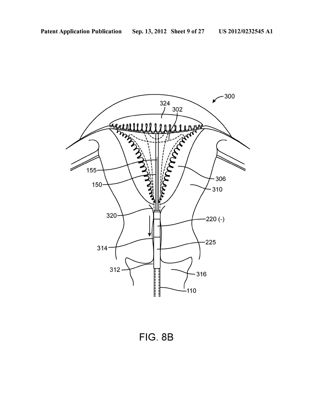 SYSTEM AND METHOD FOR ENDOMETRIAL ABLATION - diagram, schematic, and image 10