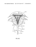 SYSTEM AND METHOD FOR ENDOMETRIAL ABLATION diagram and image