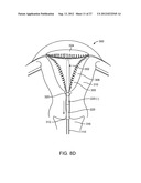 SYSTEM AND METHOD FOR ENDOMETRIAL ABLATION diagram and image