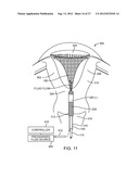 SYSTEM AND METHOD FOR ENDOMETRIAL ABLATION diagram and image