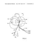 ABLATIVE TREATMENT OF THE HEART TO IMPROVE PATIENT OUTCOMES FOLLOWING     SURGERY diagram and image