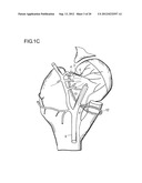 METHOD FOR IMPROVING BLOOD FLOW IN BONE HEAD diagram and image