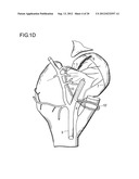 METHOD FOR IMPROVING BLOOD FLOW IN BONE HEAD diagram and image