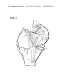 METHOD FOR IMPROVING BLOOD FLOW IN BONE HEAD diagram and image