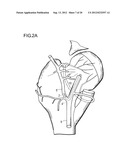 METHOD FOR IMPROVING BLOOD FLOW IN BONE HEAD diagram and image