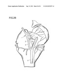 METHOD FOR IMPROVING BLOOD FLOW IN BONE HEAD diagram and image