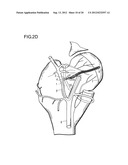 METHOD FOR IMPROVING BLOOD FLOW IN BONE HEAD diagram and image