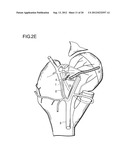 METHOD FOR IMPROVING BLOOD FLOW IN BONE HEAD diagram and image