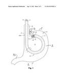 SURGICAL TREATMENT OF GASTRIC EMPTYING DISORDERS diagram and image