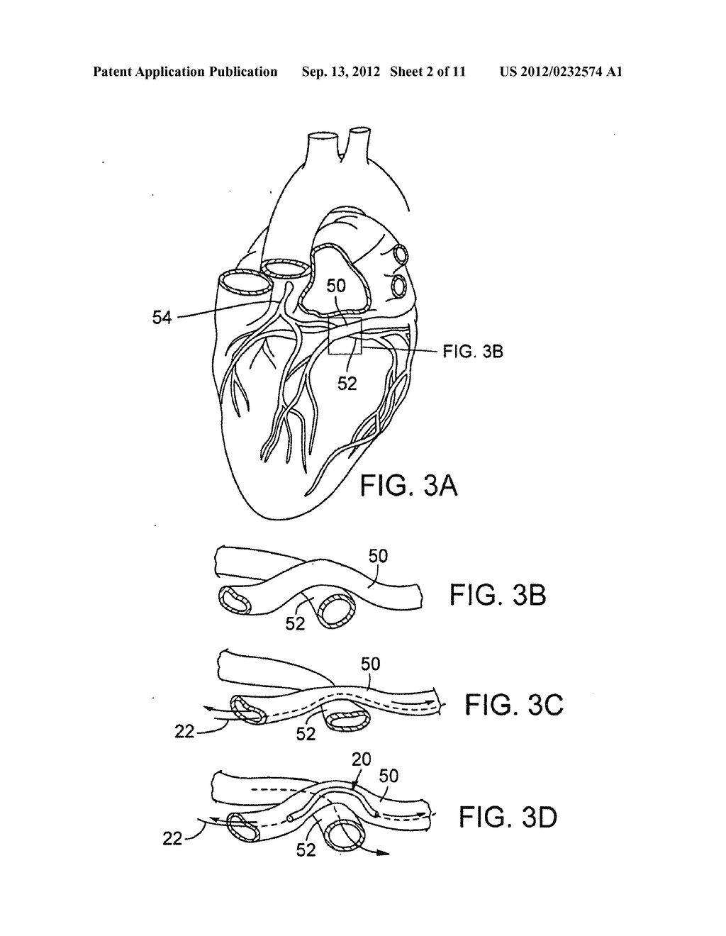 TRANSCATHETER CORONARY SINUS MITRAL VALVE ANNULOPLASTY PROCEDURE AND     CORONARY ARTERY AND MYOCARDIAL PROTECTION DEVICE - diagram, schematic, and image 03