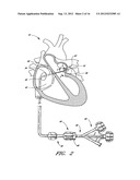 METHOD OF CLOSING AN OPENING IN A WALL OF THE HEART diagram and image