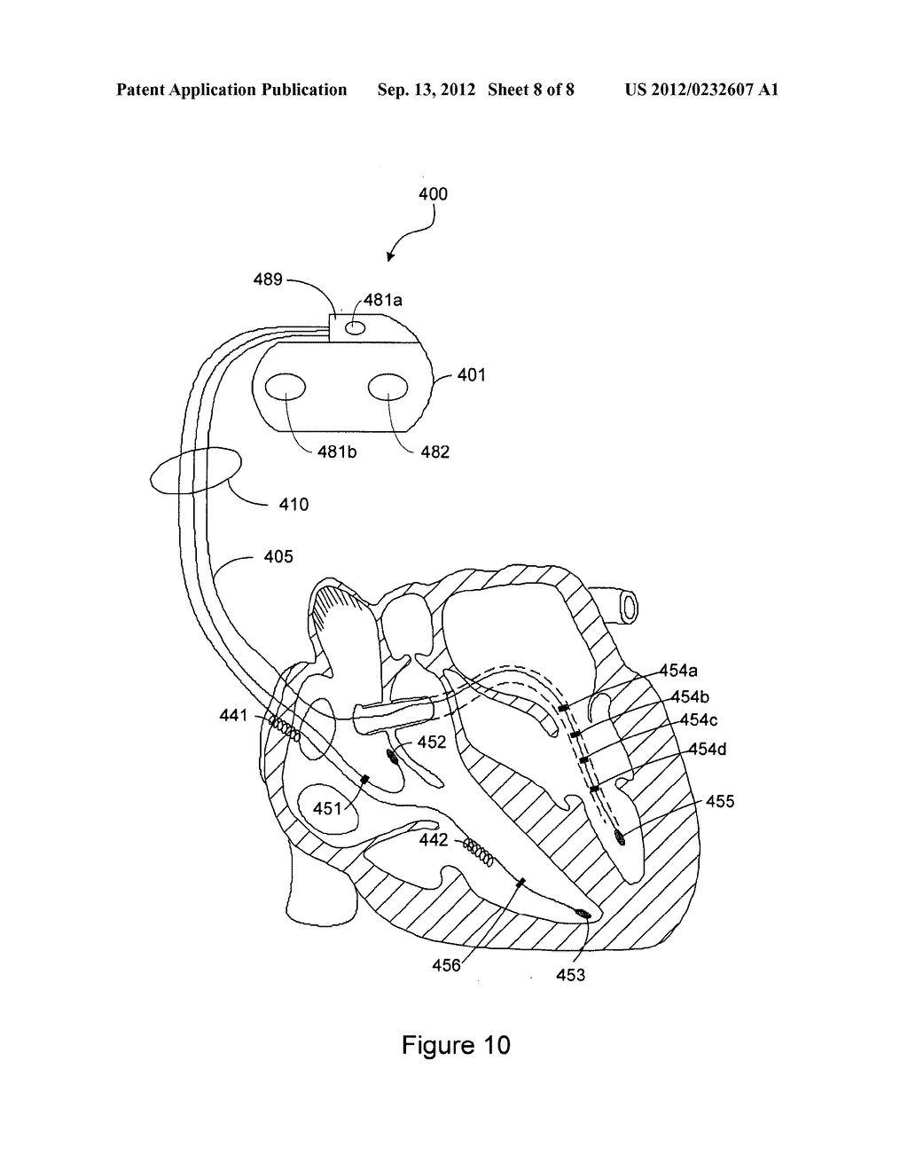 ESTIMATING ACUTE RESPONSE TO CARDIAC RESYNCHRONIZATION THERAPY - diagram, schematic, and image 09