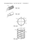 MINIMALLY INVASIVE TISSUE SUPPORT diagram and image